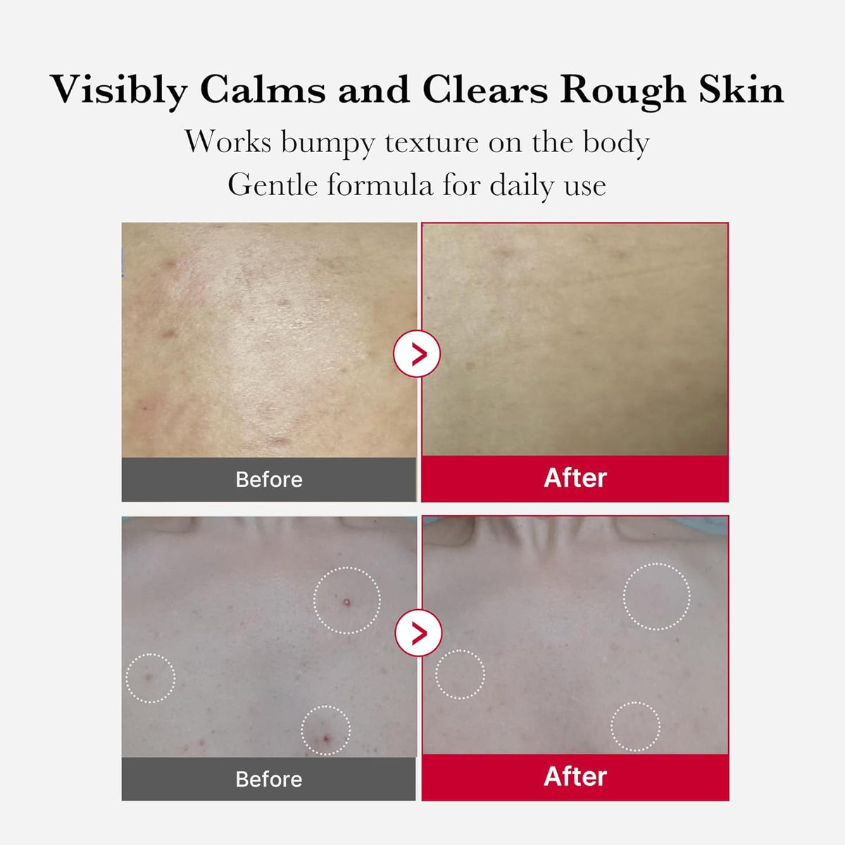 Medicube Red Acne Body Peeling Shot - 110g