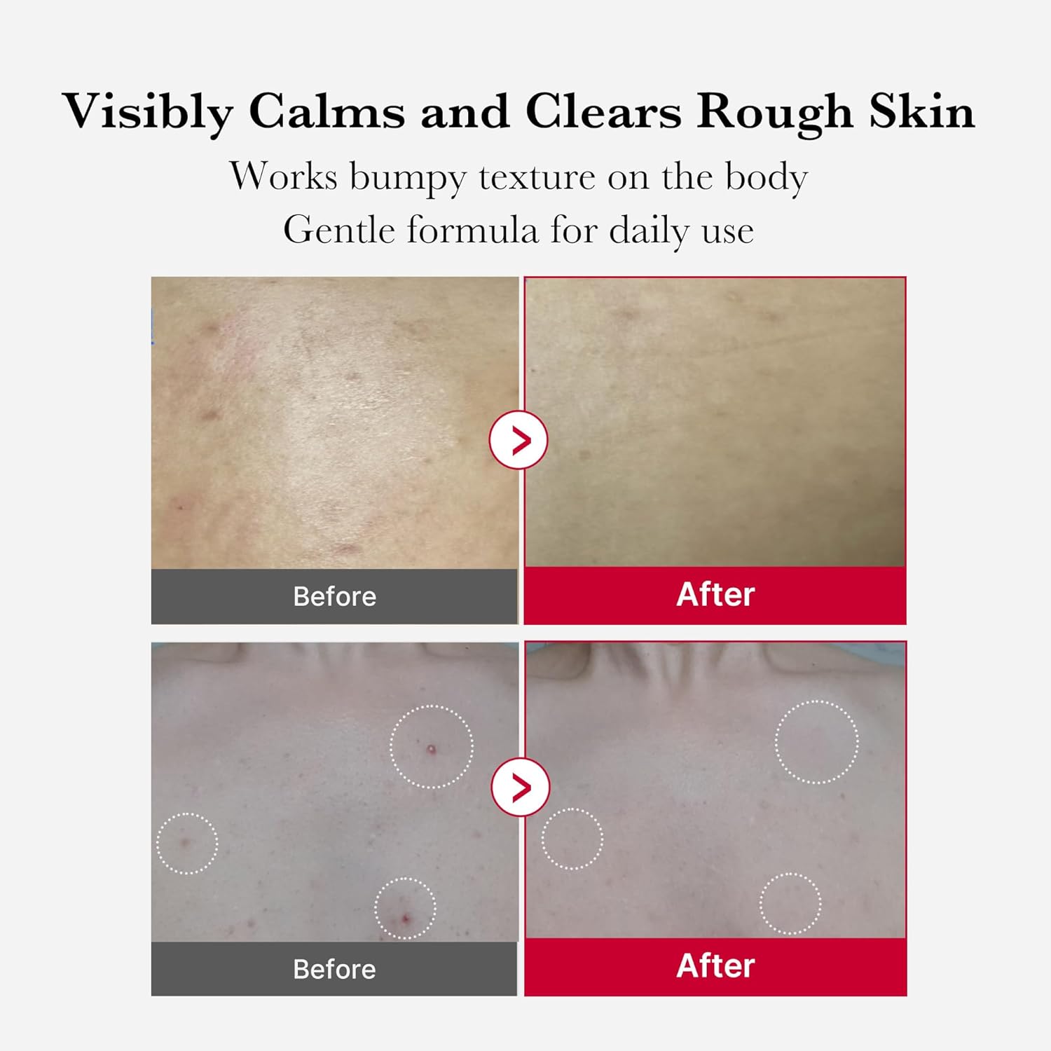 Medicube Red Acne Body Peeling Shot - 110g