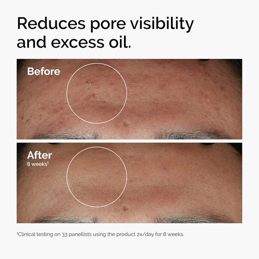 The Ordinary Niacinamide 10% + Zinc 1% - 30ml